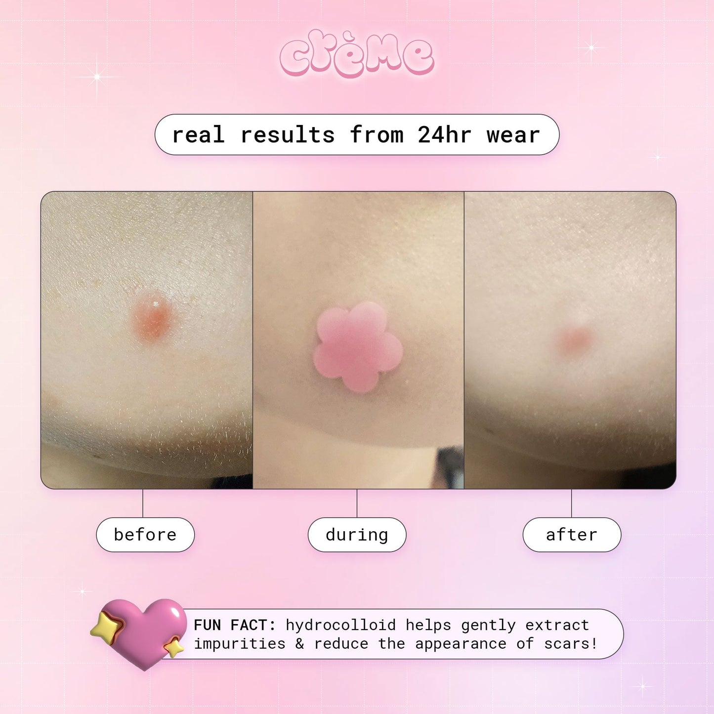 Petal Perfect Skin - Hydrocolloid Acne Patches | Pink & Holographic Hydrocolloid Acne Patches The Crème Shop