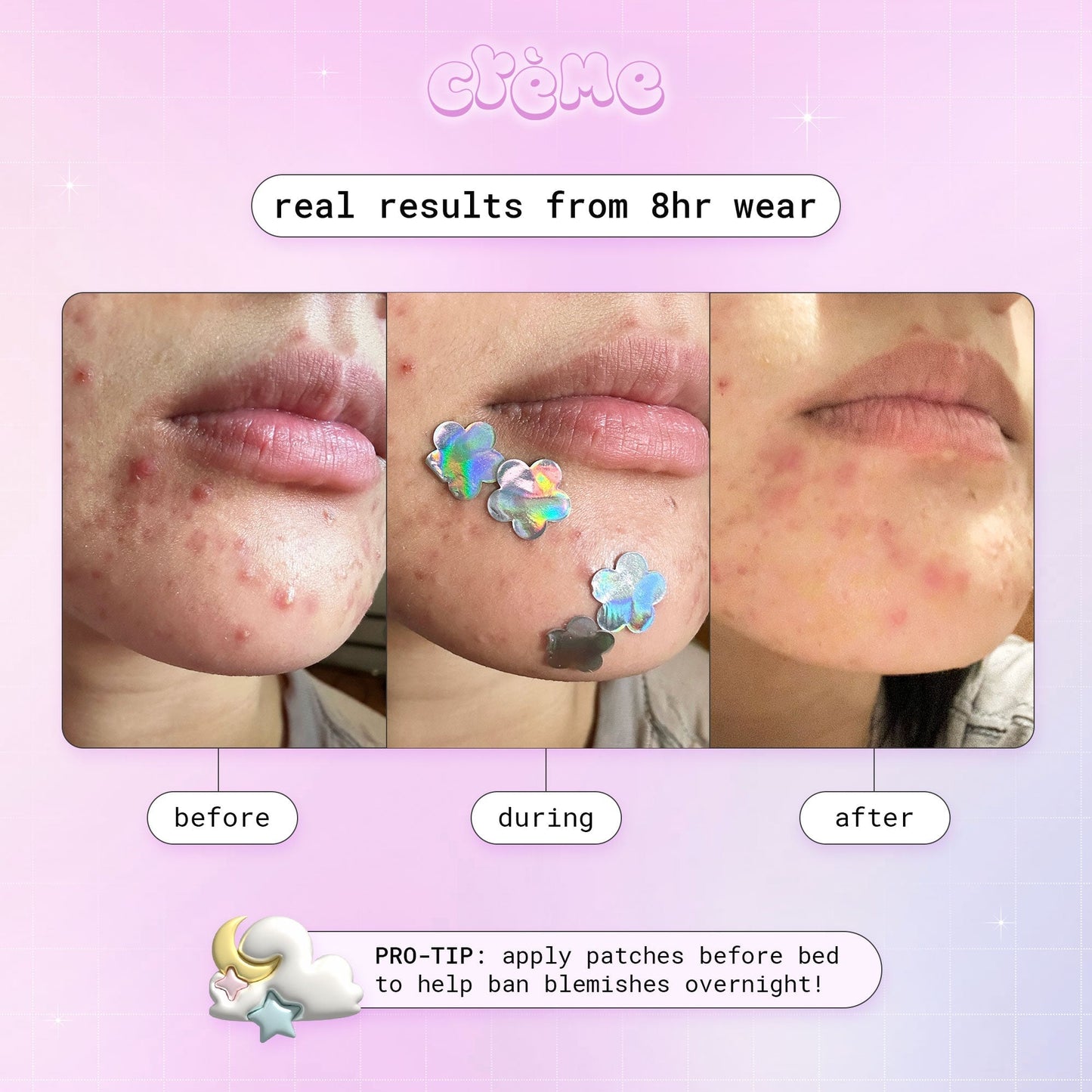 Petal Perfect Skin - Hydrocolloid Acne Patches | Pink & Holographic Hydrocolloid Acne Patches The Crème Shop