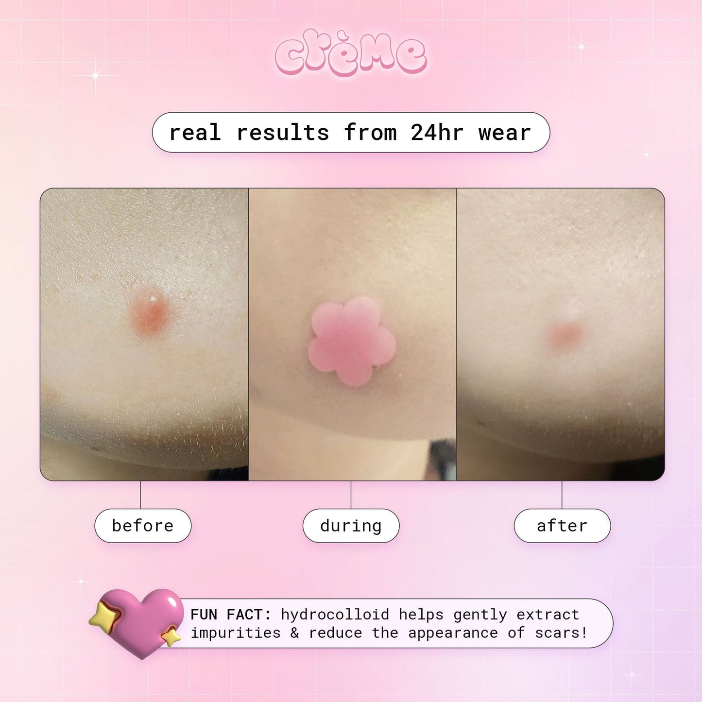 Petal Perfect Skin - Hydrocolloid Acne Patches | Pink & Holographic Hydrocolloid Acne Patches The Crème Shop 
