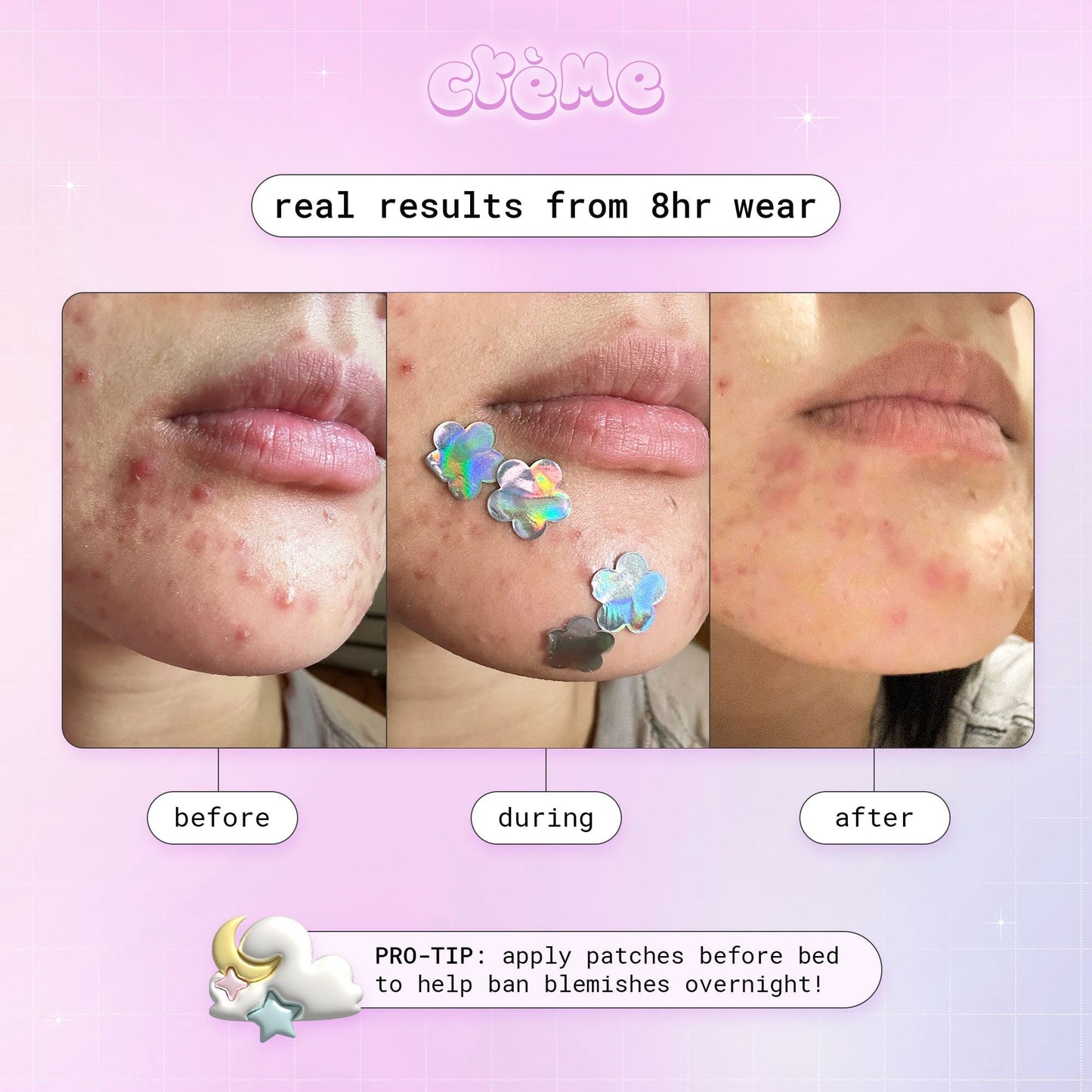Petal Perfect Skin - Hydrocolloid Acne Patches | Pink & Holographic Hydrocolloid Acne Patches The Crème Shop 